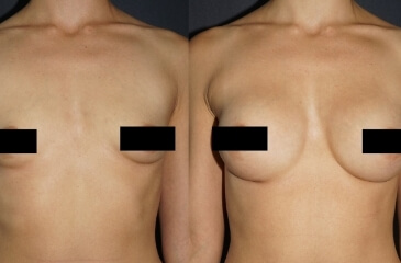 Breast augmentation before and after 01, Dr Terrence Scamp Gold Coast