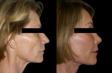 Facelift surgery before and after 01, Dr Scamp Plastic Surgeon Gold Coast