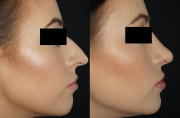Rhinoplasty (nose job) before and after 01, Dr Terrence Scamp Gold Coast