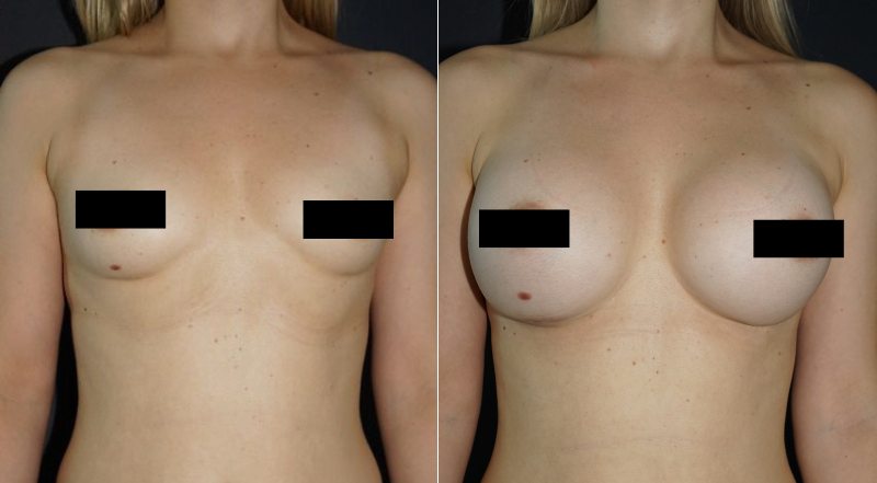 Copy of TS Breast Lift 2 Gallery - 1