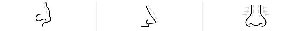 Rhinoplasty